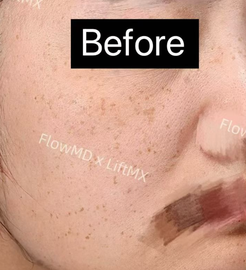 Skin Rejuvenation - Before