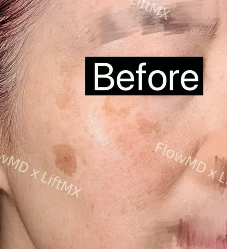 Fine Line Reduction - Before