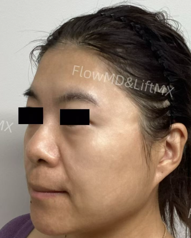 Facial Contouring - Before