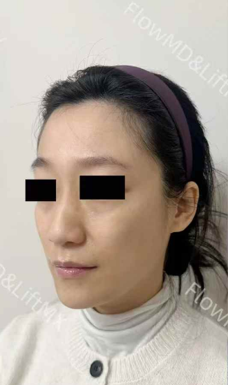 Pigmentation Correction - Before